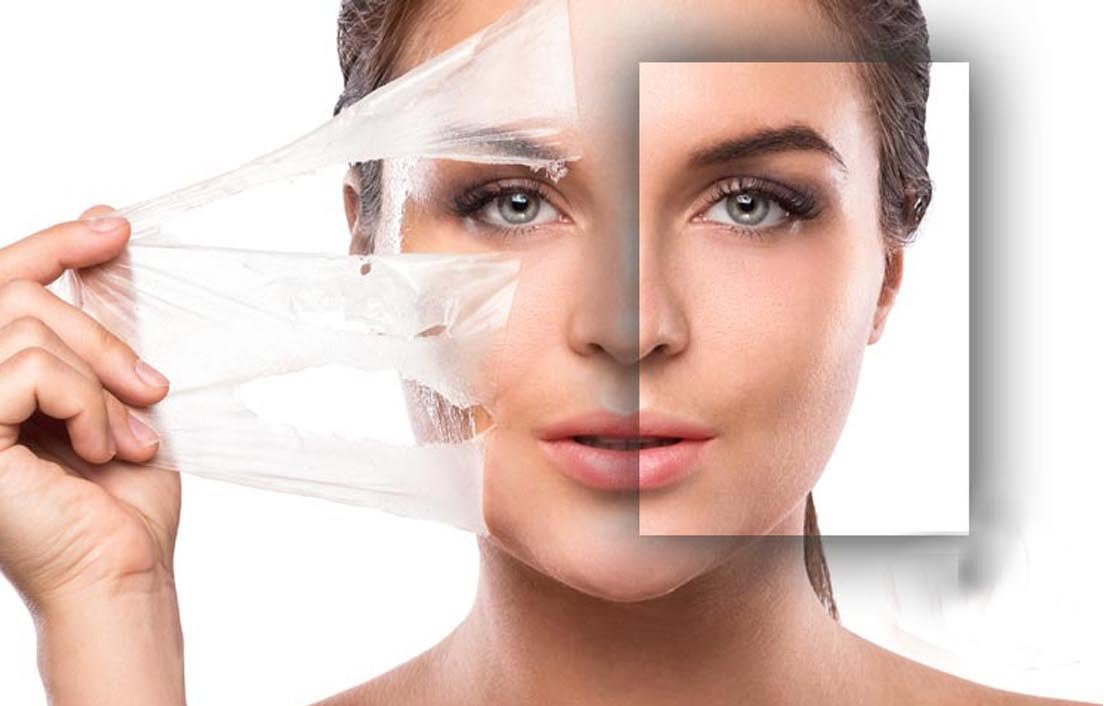 Chemical-Peels