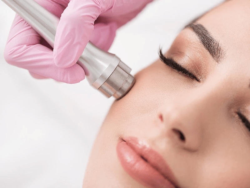 microdermabrasion