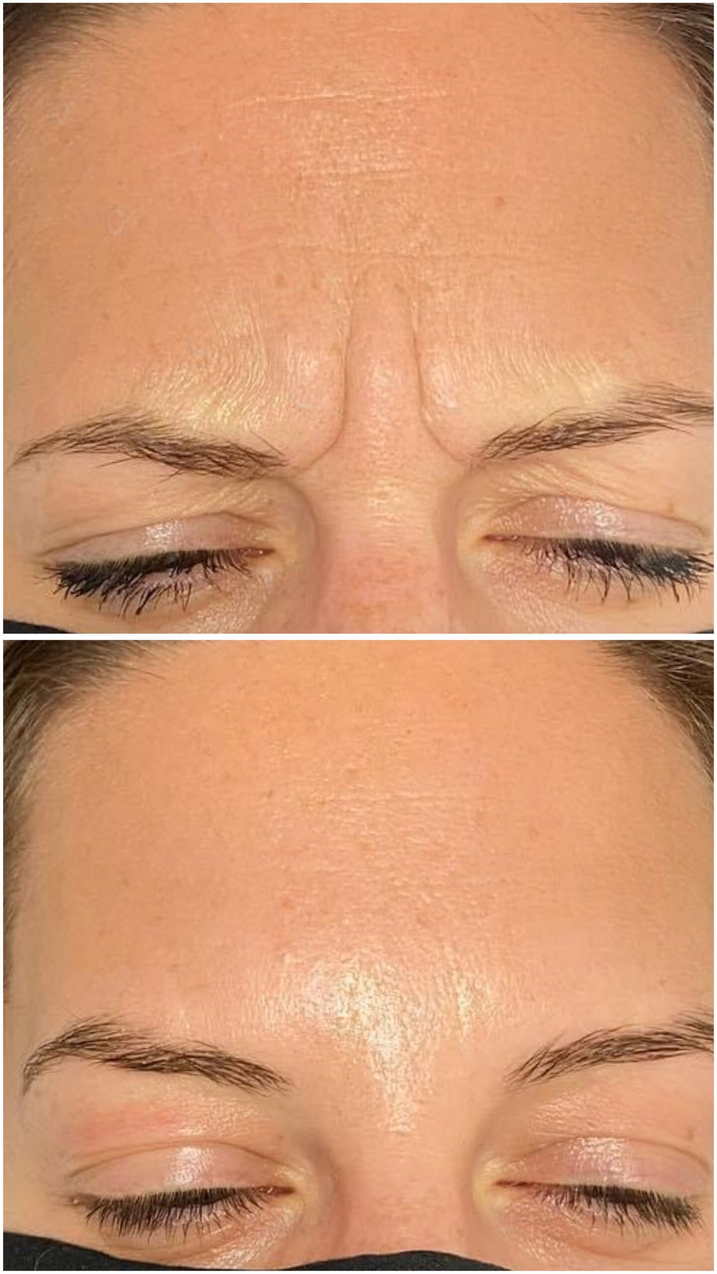 Dysport botox